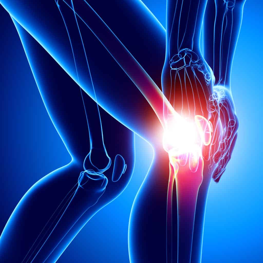 arthritis causing knee pain